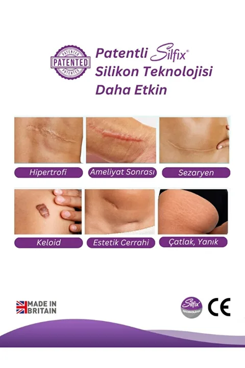 Advancis Medical UK Siltape Soft Silikon Bant Estetik Keloid Yanık Sezaryen Dikiş Ameliyat Izi Giderici 2cm X 3mt 4
