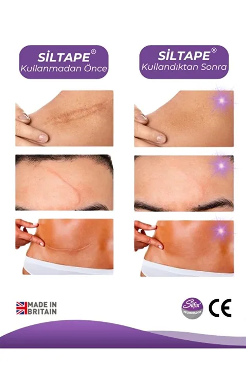 Advancis Medical UK Siltape Soft Silikon Bant Estetik Keloid Yanık Sezaryen Dikiş Ameliyat Izi Giderici 2cm X 3mt 6