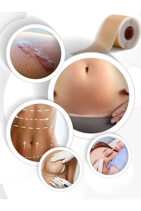 ZoneTAPE Soft Silikon Bant -kırışıklık-estetik-dikiş-skar-keloid-sezaryen-karın/kol/bacak Germe-ben Aldırma 2